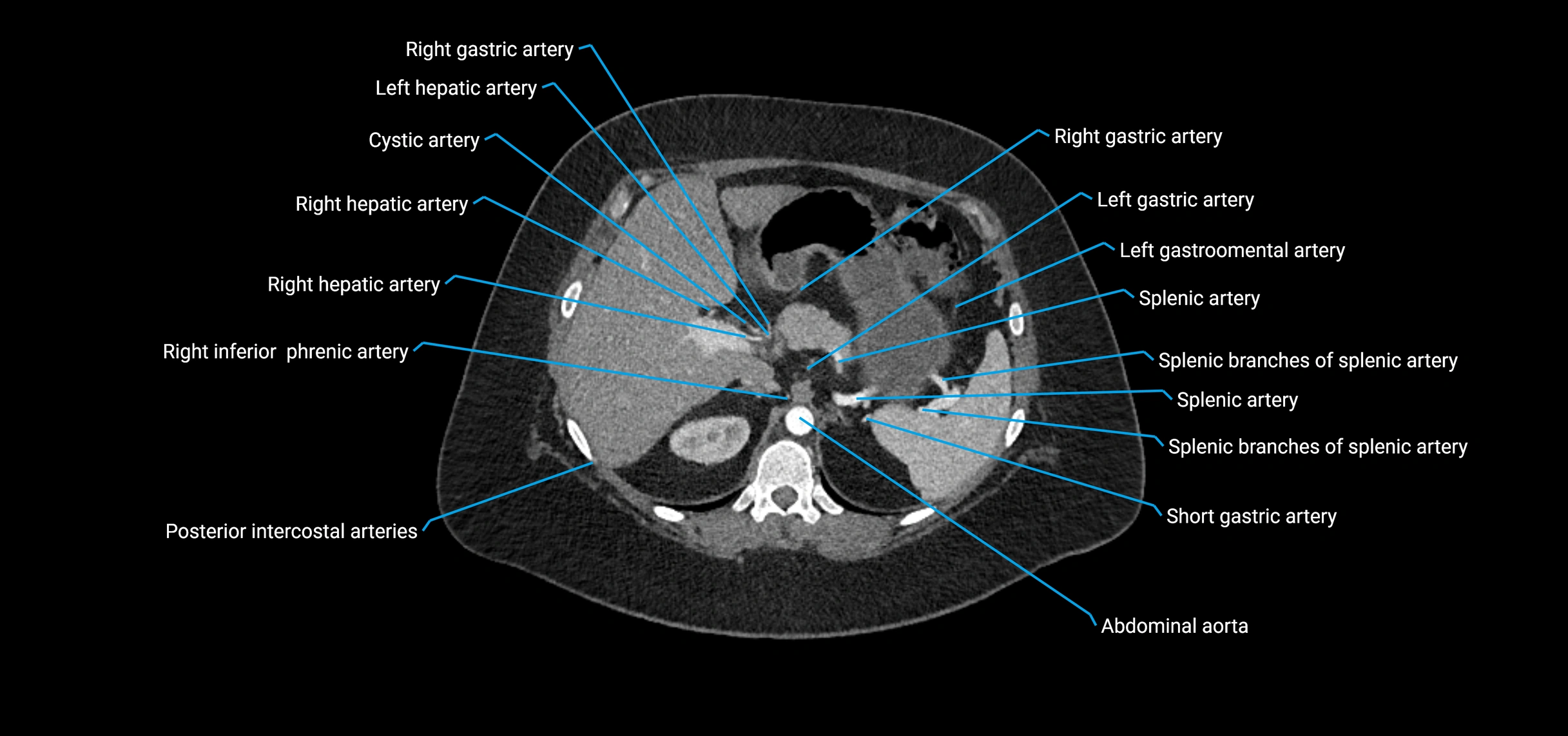 CTA abdomen axial cross sectional anatomy labelled image_45 (2).webp